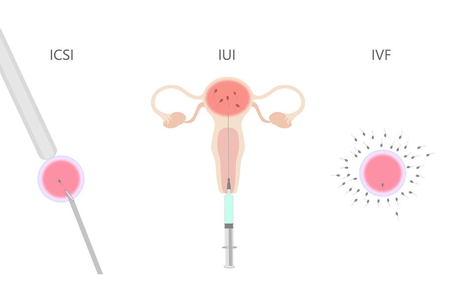 เด็กหลอดแก้ว (IVF) และการทำอิ๊กซี่ (ICSI) คืออะไรและแตกต่างกันอย่างไร